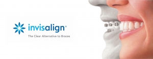 Invisalign FAQs: Your Top Questions Answered